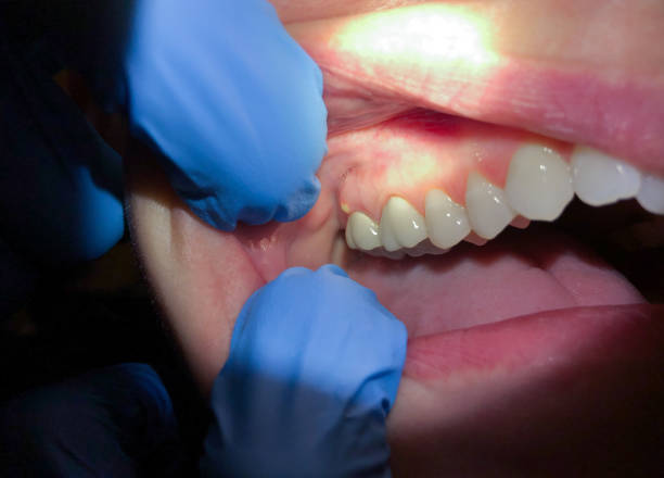Best Emergency Care for Gum Disease in Port Ludlow, WA