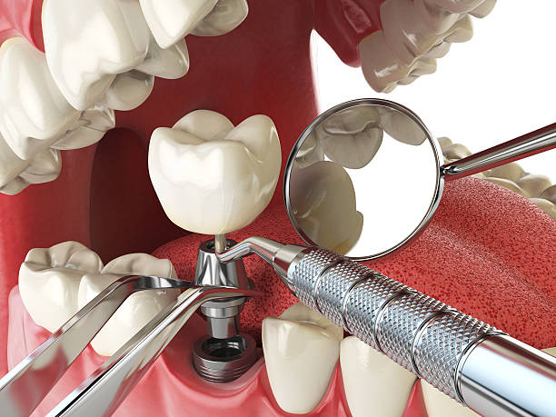 Best Emergency Denture Repair in Port Ludlow, WA