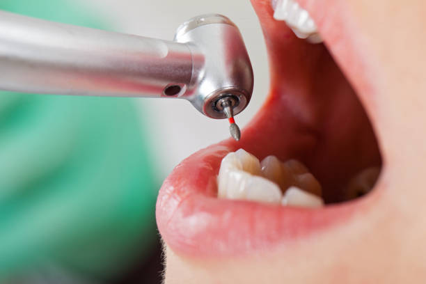 Best Lost Filling or Crown Replacement in Port Ludlow, WA